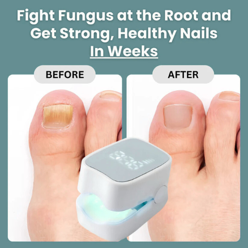 Peakpicks™ - Nail Fungus Laser Device